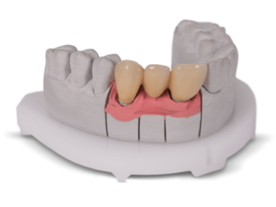 gingiva MASK 3D Implantat